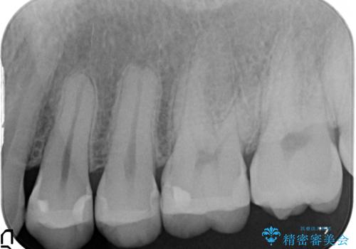 虫歯を治したい、セラミックによる治療の治療後
