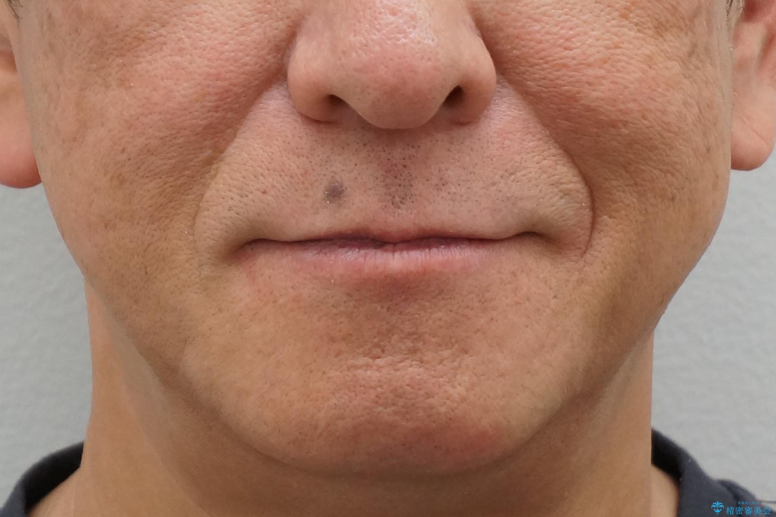 50代男性　受け口　他院で5年以上かかると治療を断られたの治療後（顔貌）