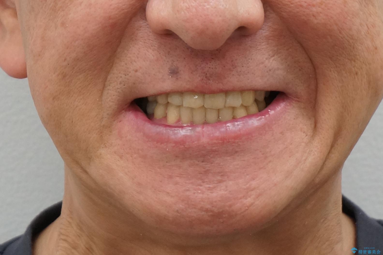 50代男性 受け口 他院で5年以上かかると治療を断られたの治療後(顔貌)