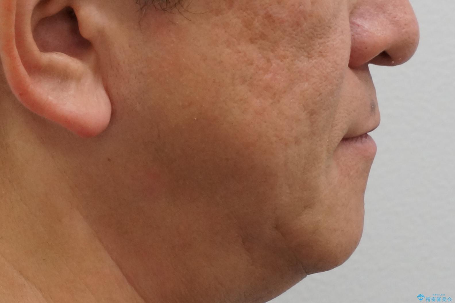 50代男性 受け口 他院で5年以上かかると治療を断られたの治療後(顔貌)