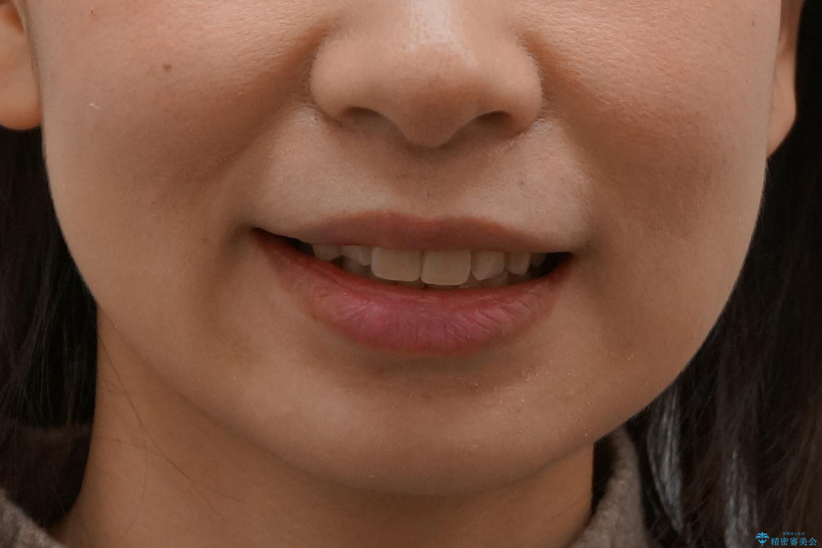 歯並びのがたつきを直したい ワイヤーは嫌 抜きたくないの治療後(顔貌)