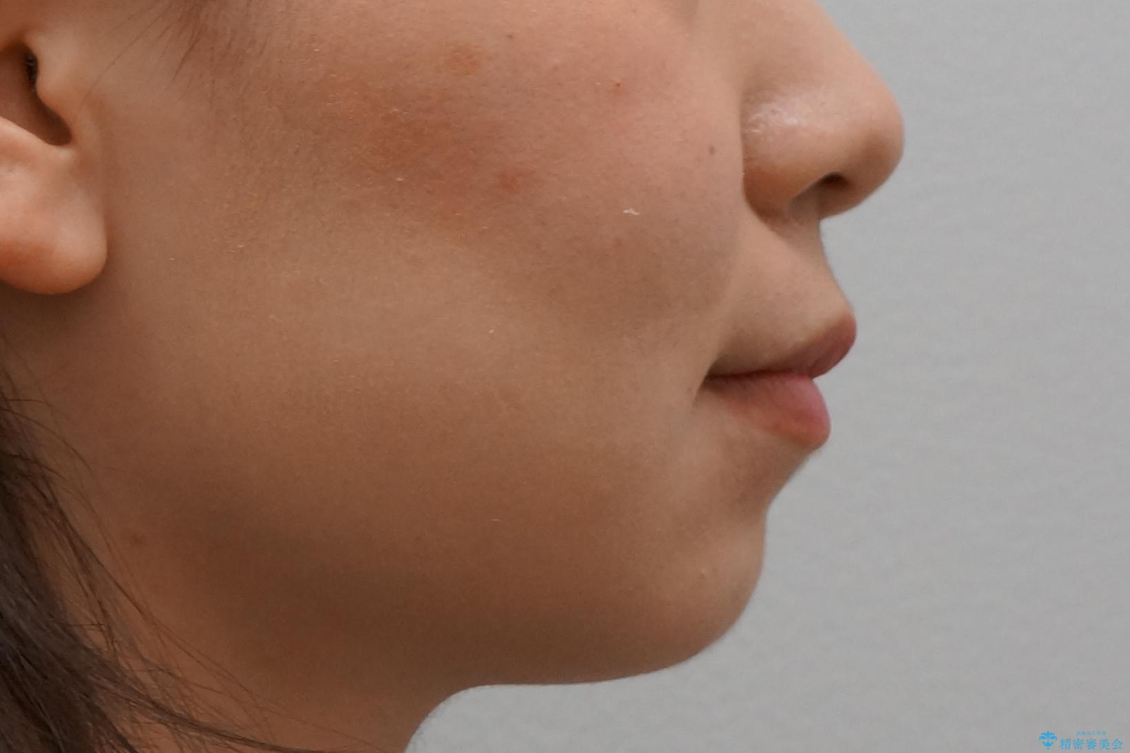 歯並びのがたつきを直したい ワイヤーは嫌 抜きたくないの治療後(顔貌)