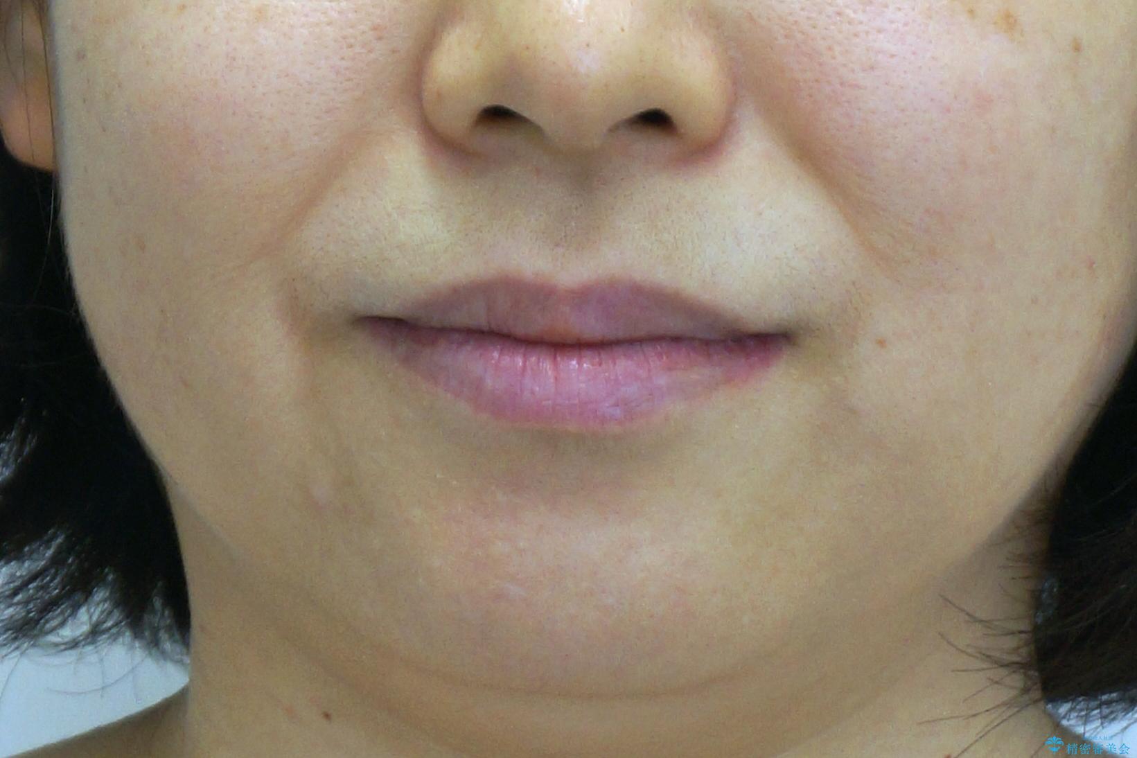 前歯のガタガタ 治療期間がかかっても良いので非抜歯でマウスピースでの治療後(顔貌)