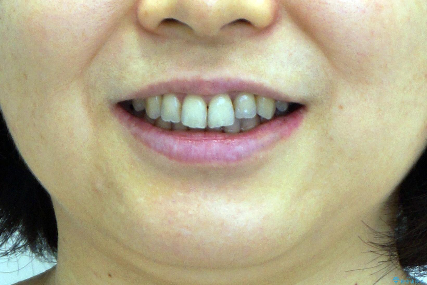 前歯のガタガタ　治療期間がかかっても良いので非抜歯でマウスピースでの治療後（顔貌）