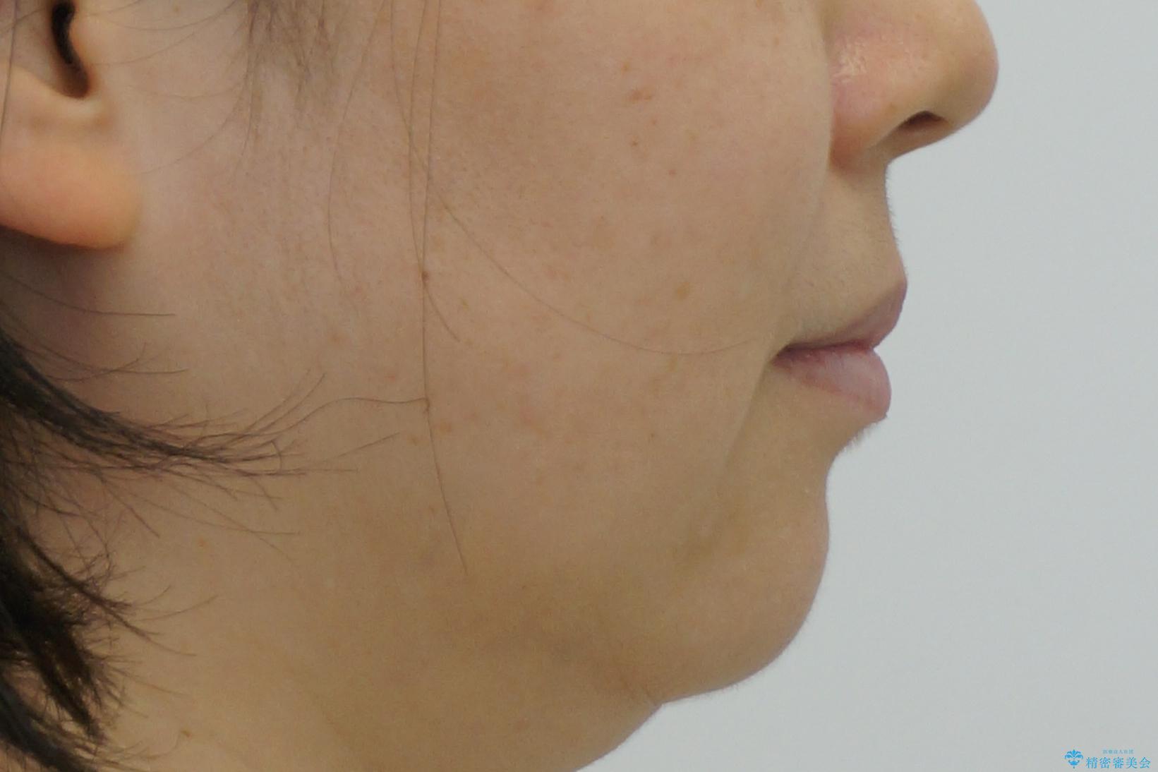 前歯のガタガタ 治療期間がかかっても良いので非抜歯でマウスピースでの治療後(顔貌)