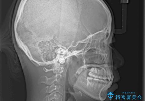 前歯のクロスバイトをインビザライン矯正で改善の治療前