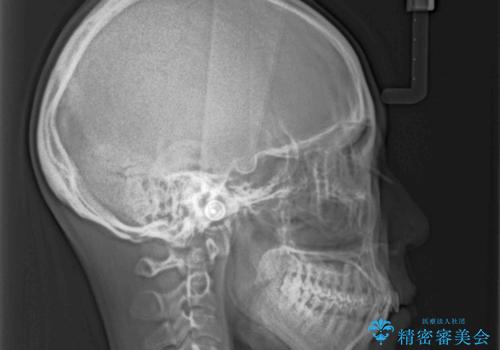 前歯のデコボコを治したい 費用を抑えた抜歯矯正の治療前