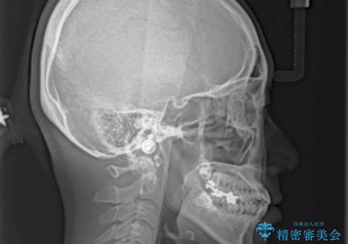 話しにくい歯並びの改善 抜歯矯正治療と前歯の審美治療の治療前