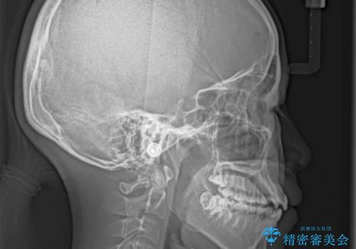 口元をスッキリと ワイヤーでの抜歯矯正の治療前