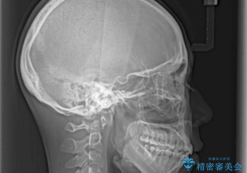 前歯のデコボコを治したい 費用を抑えた抜歯矯正の治療後