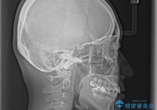 話しにくい歯並びの改善 抜歯矯正治療と前歯の審美治療の治療後
