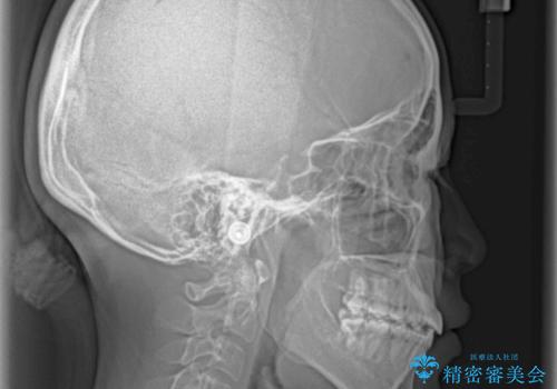 口元をスッキリと ワイヤーでの抜歯矯正の治療後