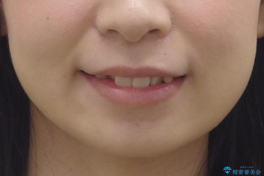 歯並びのがたつきを直したい ワイヤーは嫌 抜きたくないの治療前(顔貌)