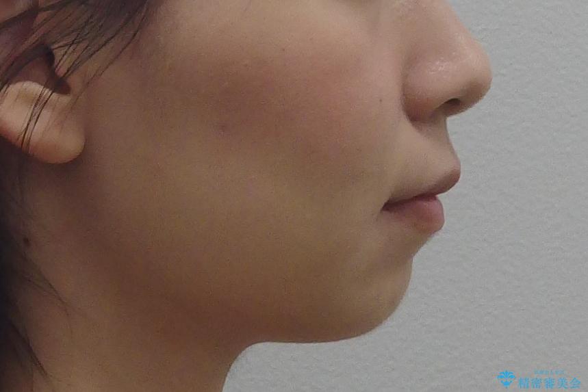 歯並びのがたつきを直したい ワイヤーは嫌 抜きたくないの治療前(顔貌)