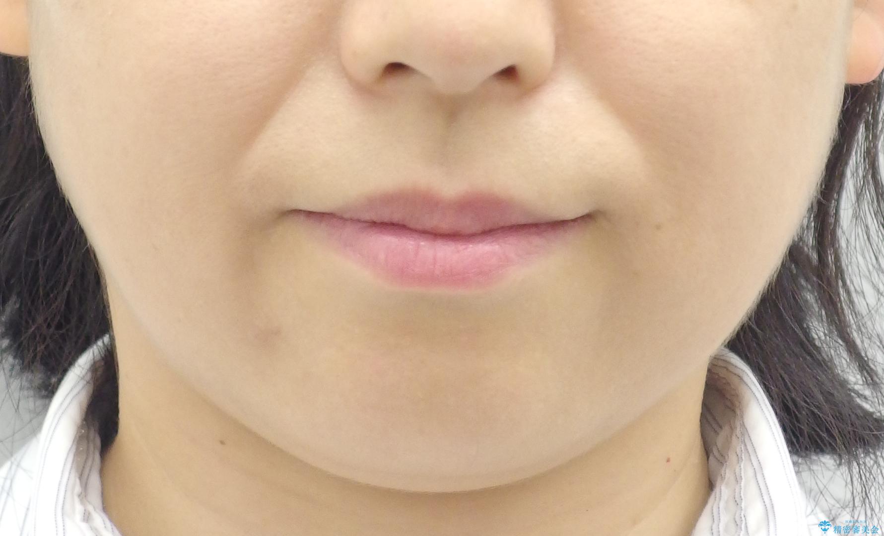 前歯のガタガタ 治療期間がかかっても良いので非抜歯でマウスピースでの治療前(顔貌)