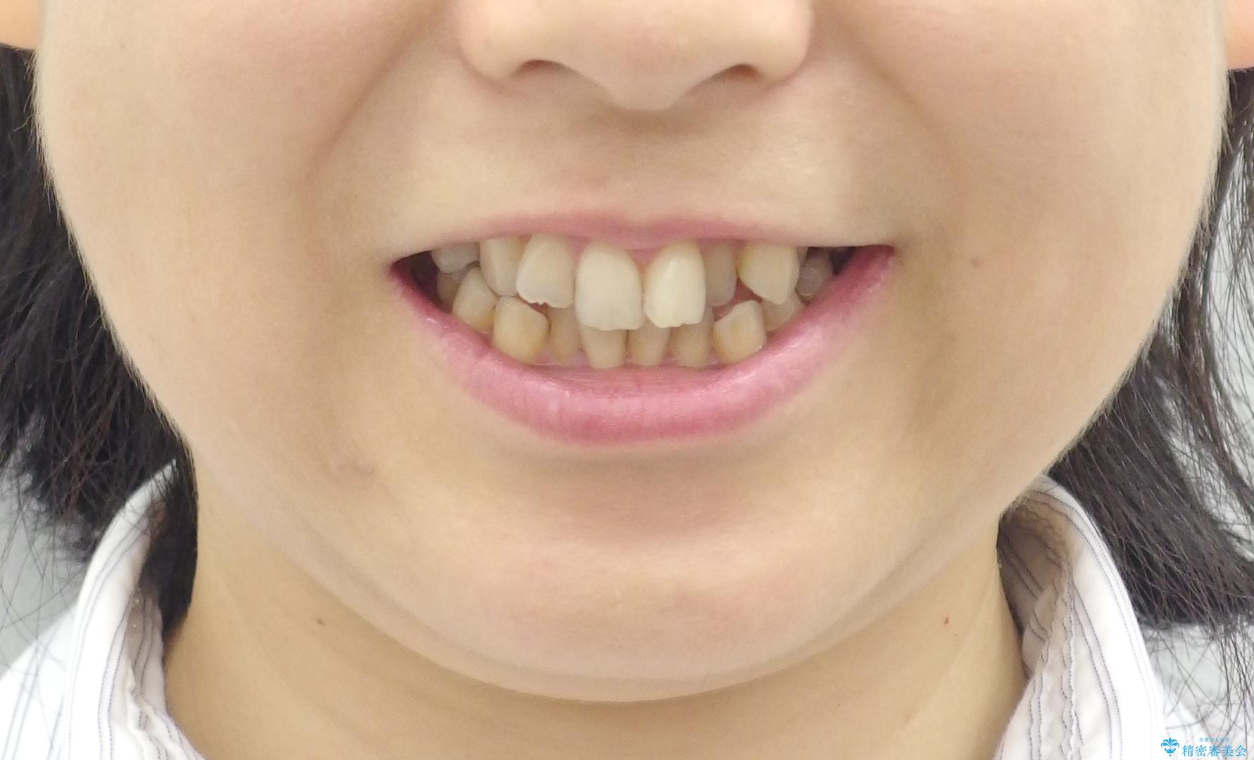 前歯のガタガタ 治療期間がかかっても良いので非抜歯でマウスピースでの治療前(顔貌)