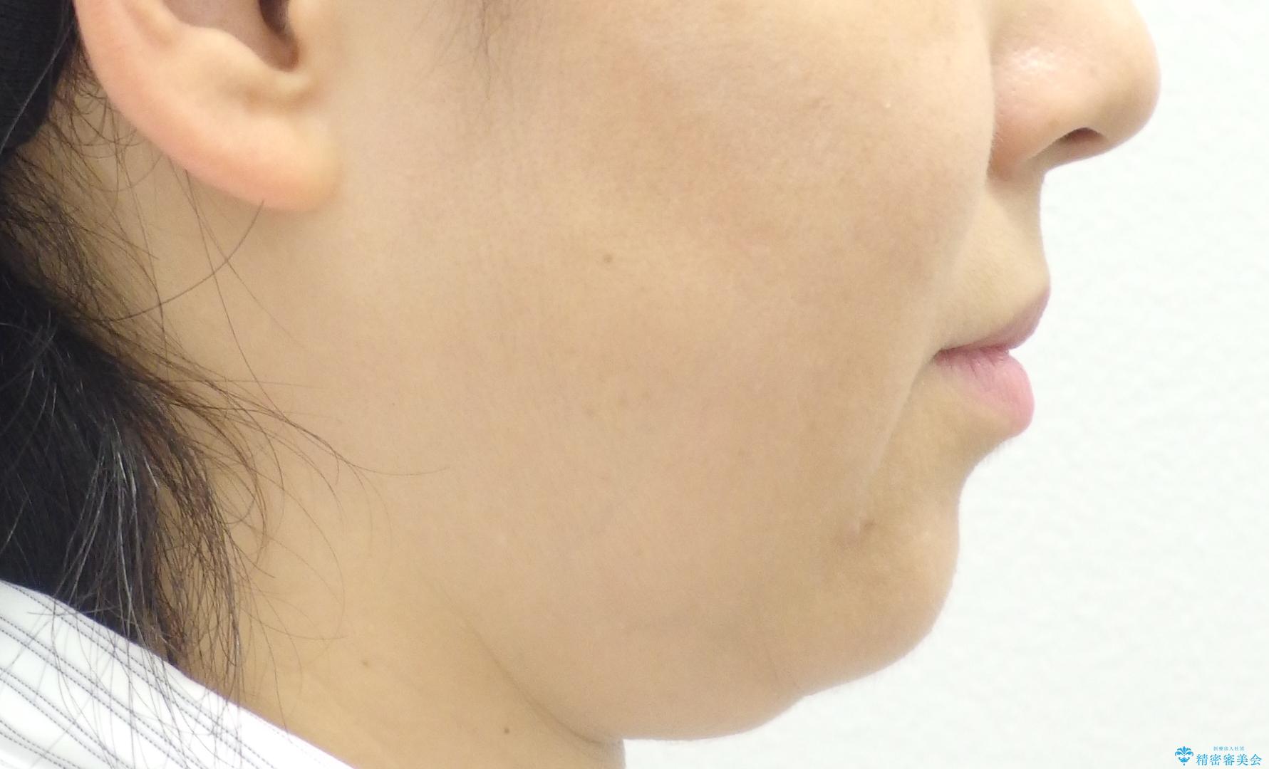 前歯のガタガタ 治療期間がかかっても良いので非抜歯でマウスピースでの治療前(顔貌)