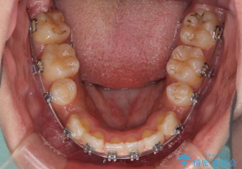 口元をスッキリと ワイヤーでの抜歯矯正の治療中