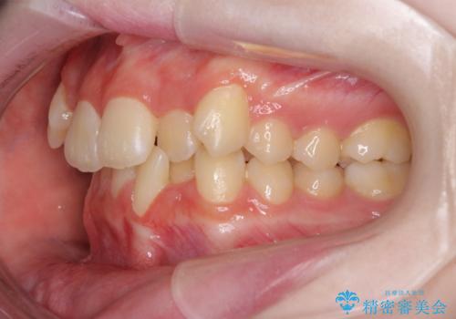 前歯をきれいに整えたい ワイヤー装置での非抜歯矯正の治療前