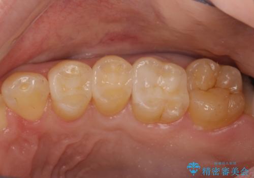 虫歯を治したい、セラミックによる治療の症例 治療後