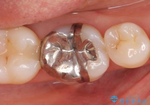 オールセラミッククラウン　目立つ銀歯を白い歯への症例 治療前