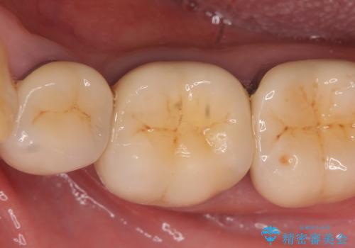 オールセラミッククラウン 痛くて咬めない奥歯の治療の治療前