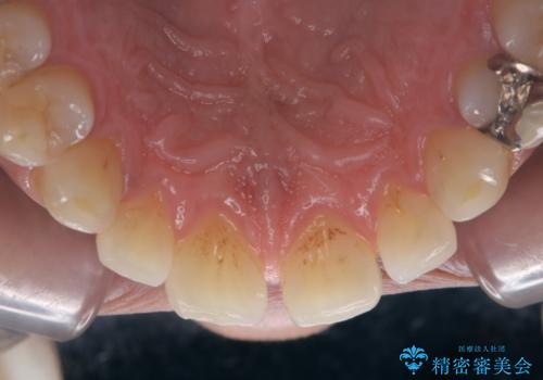 歯の着色落としの治療前