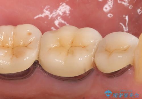 オールセラミッククラウン 痛くて咬めない奥歯の治療の治療前