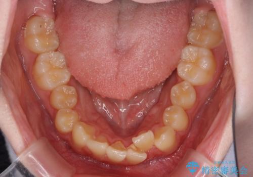 前歯をきれいに整えたい ワイヤー装置での非抜歯矯正の治療前