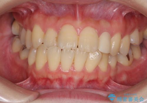 話しにくい歯並びの改善　抜歯矯正治療と前歯の審美治療の治療前