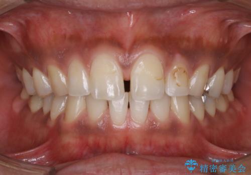 歯の着色落としの症例 治療後