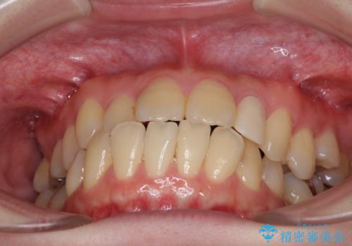 話しにくい歯並びの改善 抜歯矯正治療と前歯の審美治療の治療前