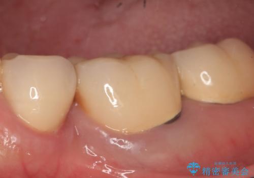 オールセラミッククラウン 痛くて咬めない奥歯の治療の症例 治療前