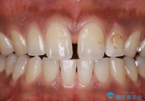 歯の着色落としの治療後