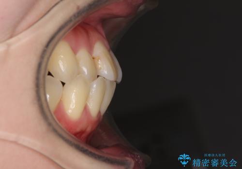 話しにくい歯並びの改善 抜歯矯正治療と前歯の審美治療の治療前
