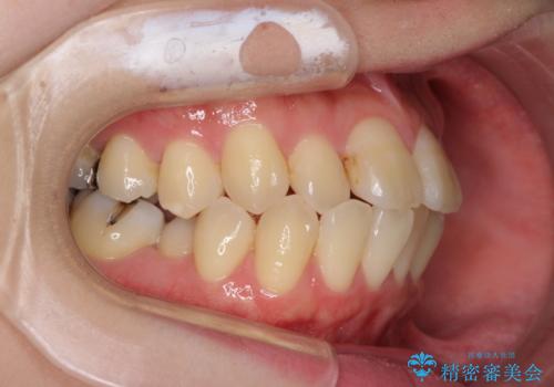話しにくい歯並びの改善 抜歯矯正治療と前歯の審美治療の治療前