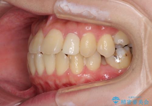 話しにくい歯並びの改善 抜歯矯正治療と前歯の審美治療の治療前