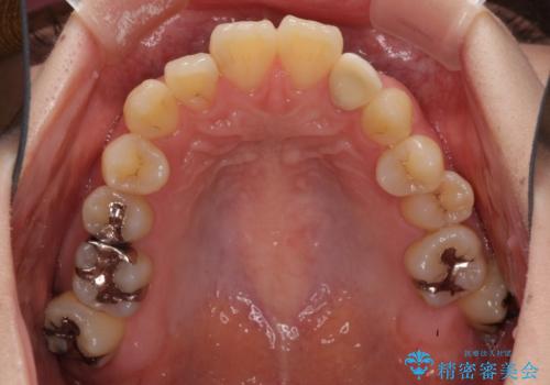 話しにくい歯並びの改善 抜歯矯正治療と前歯の審美治療の治療前