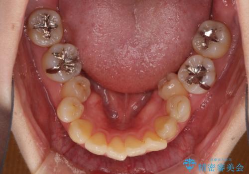 話しにくい歯並びの改善　抜歯矯正治療と前歯の審美治療の治療前