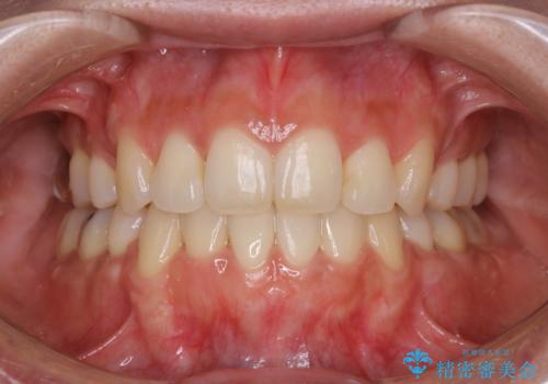 矯正治療が終了してからのメンテナンスの症例 治療前