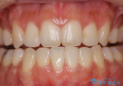 矯正治療が終了してからのメンテナンスの治療前