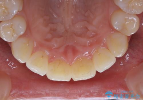 矯正治療が終了してからのメンテナンスの治療前