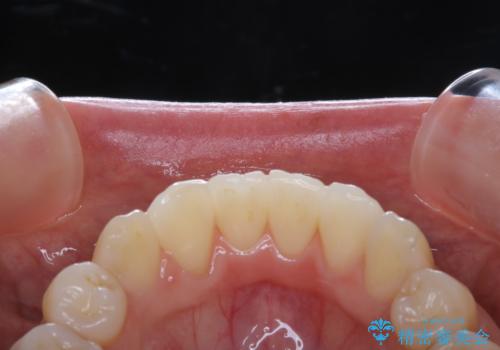 矯正治療が終了してからのメンテナンスの治療前