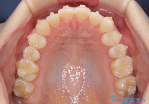 前歯のクロスバイトをインビザライン矯正で改善の治療中