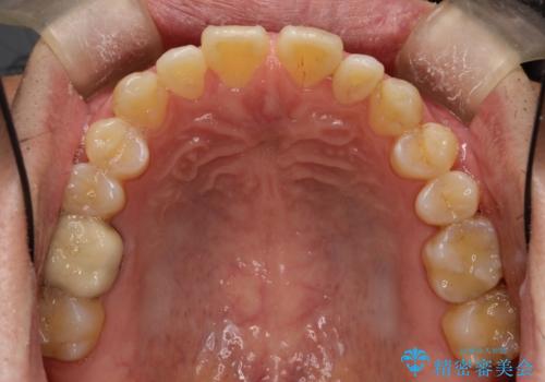 前歯の隙間　インビザラインにて整った歯並びへの治療前