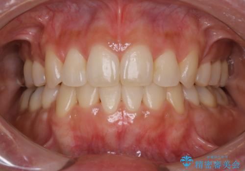 矯正治療が終了してからのメンテナンス