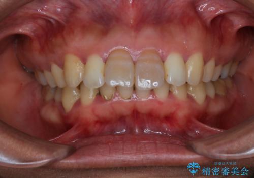 歯を白くしたい‐ウォーキングブリーチで内側から白くの治療前