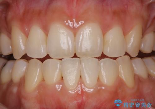 矯正治療が終了してからのメンテナンスの治療後