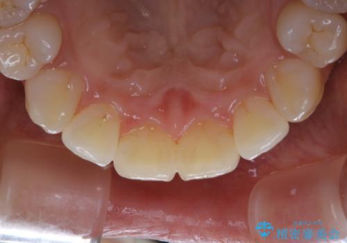 矯正治療が終了してからのメンテナンスの治療後