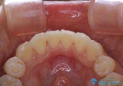 矯正治療が終了してからのメンテナンスの治療後